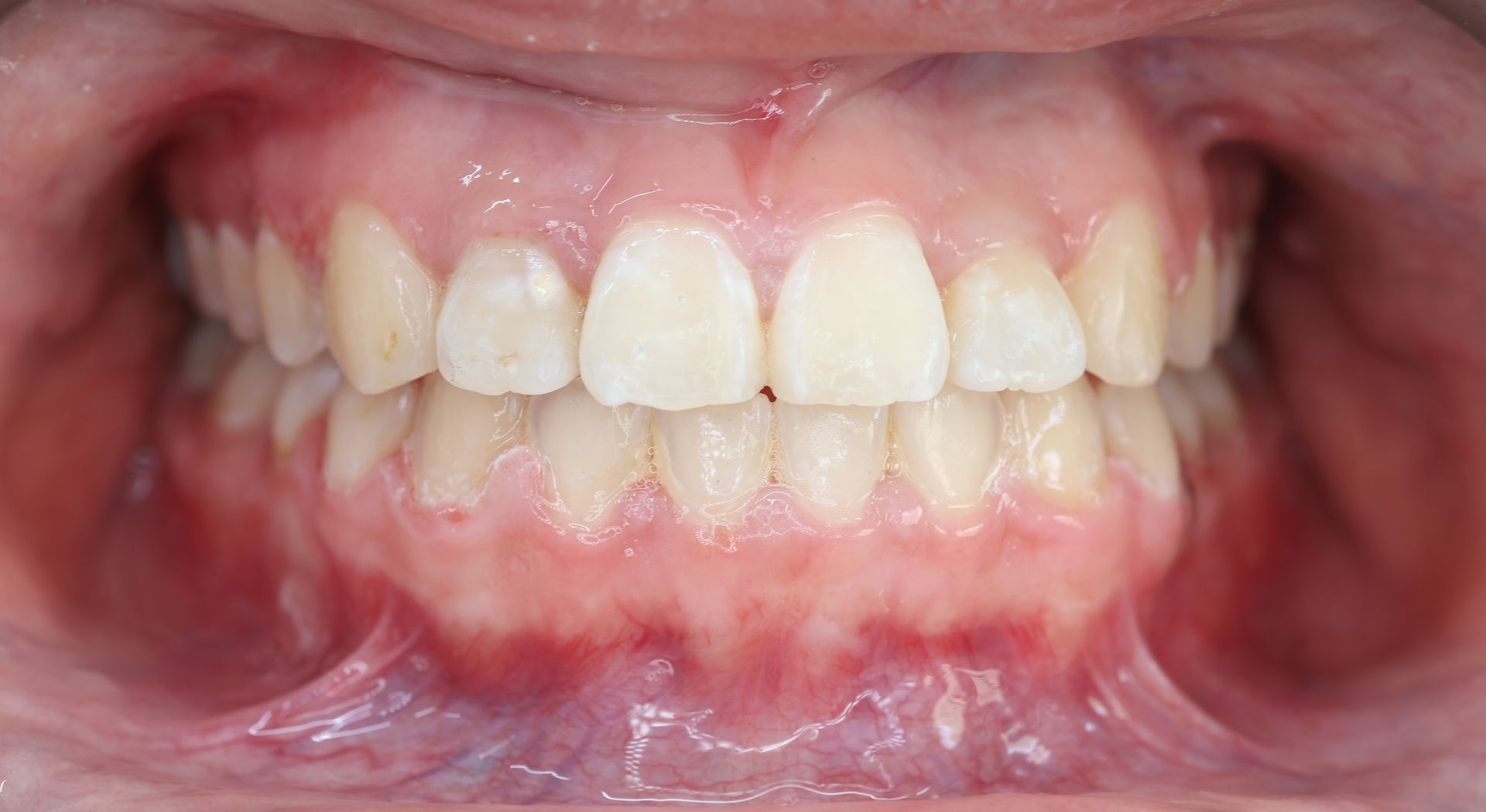 A close up of a person 's teeth and mouth.