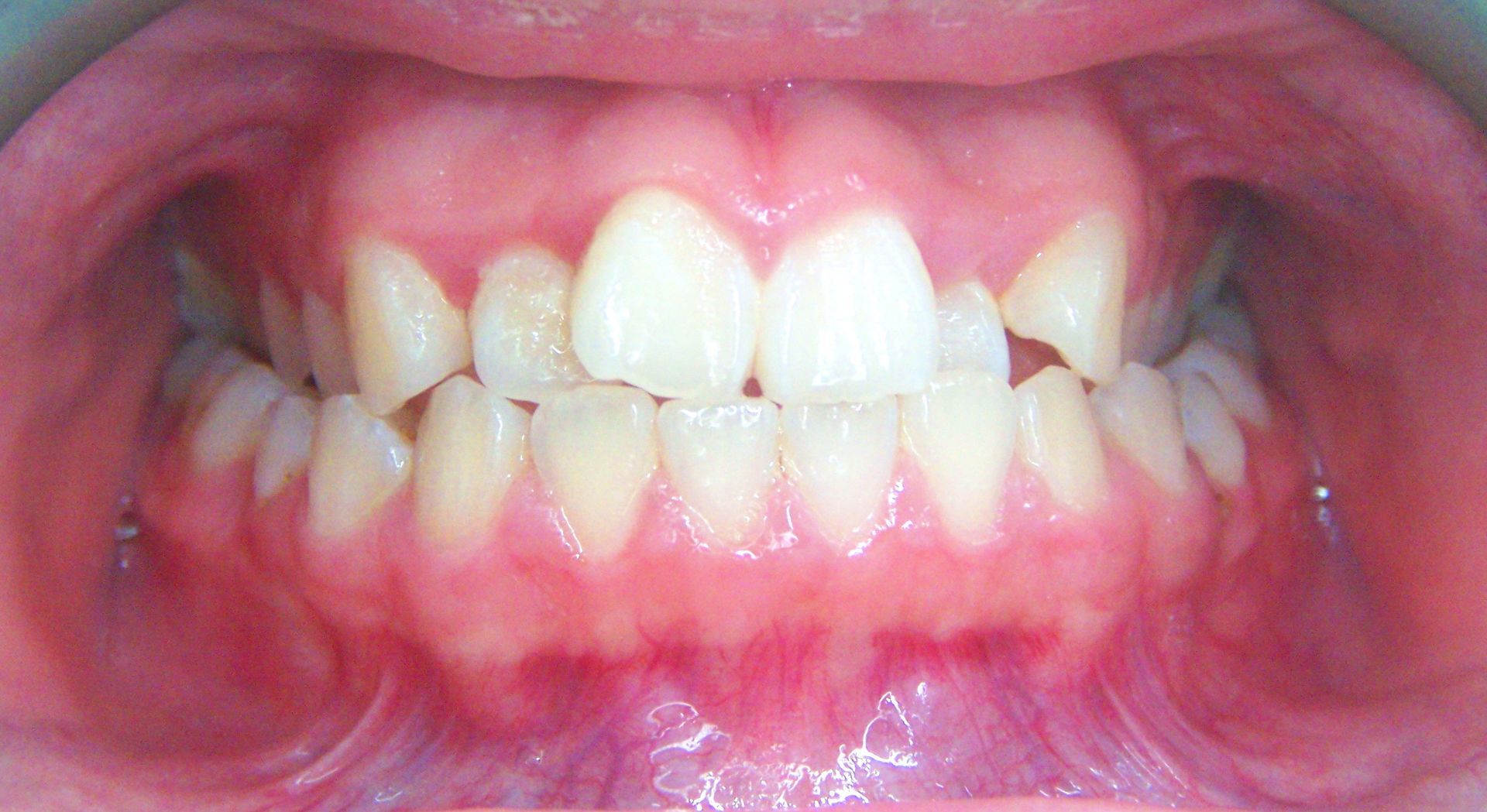 A close up of a person 's teeth and mouth.