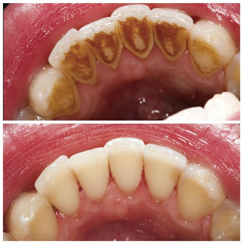 Teeth Cleaning Colleyville, Tx