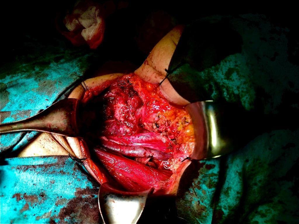 Dr. Rafael Vázquez - Treatment of Thryoid Cancer