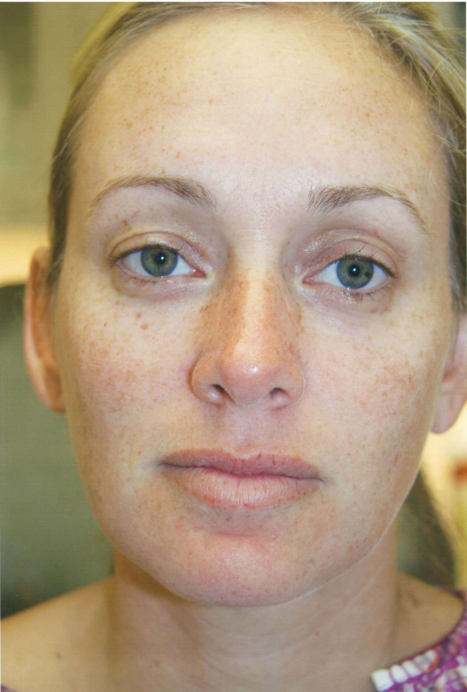 Woman with fair skin, freckles, and blue eyes.
