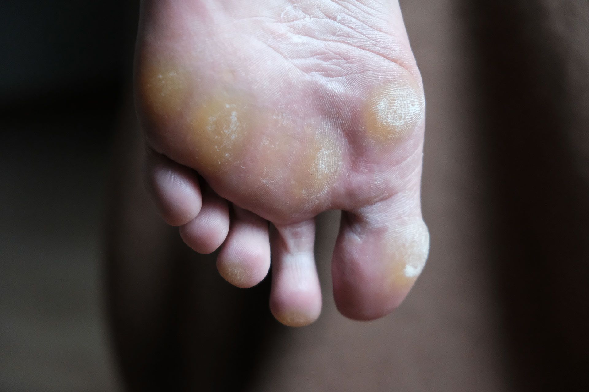 Calluses