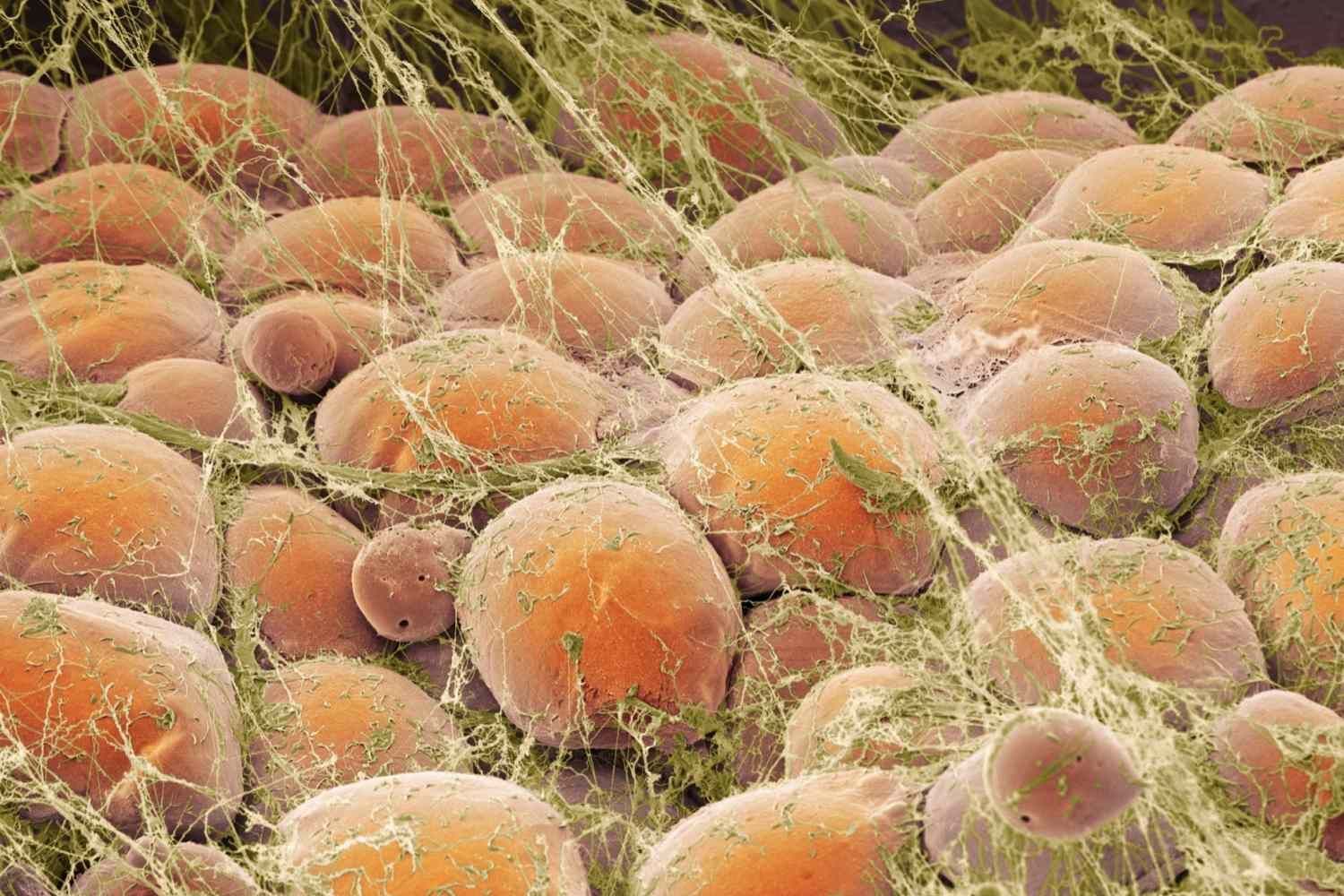 unhealthy fat cells