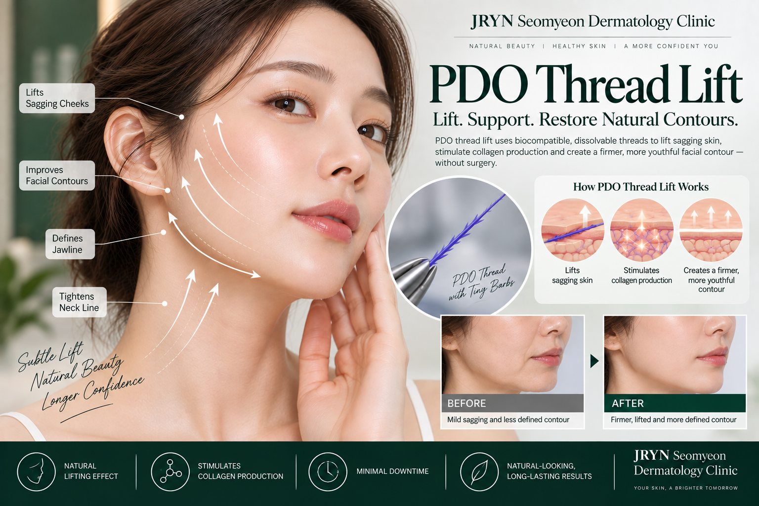 PDO thread lift procedure at JRYN Seomyeon Dermatology Clinic