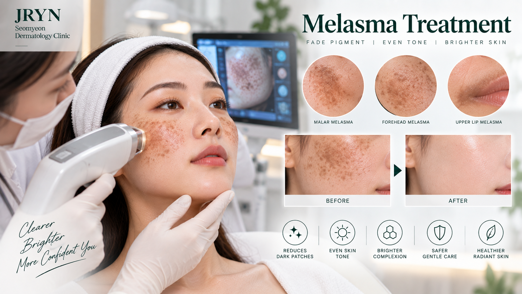 Melasma treatment clinic in Seomyeon Busan