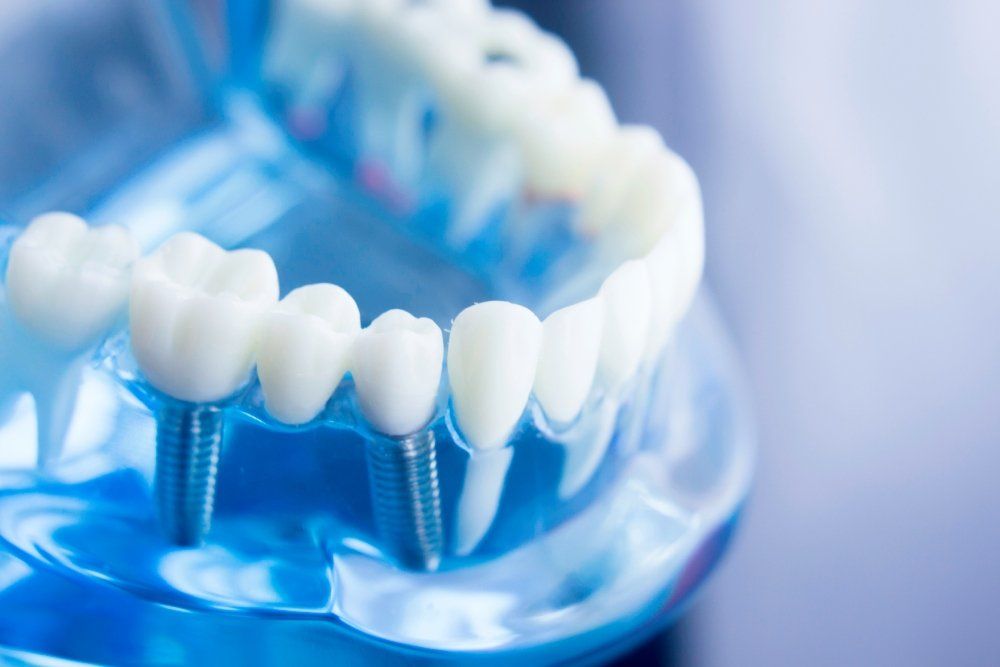 chirurgia implantare avanzata