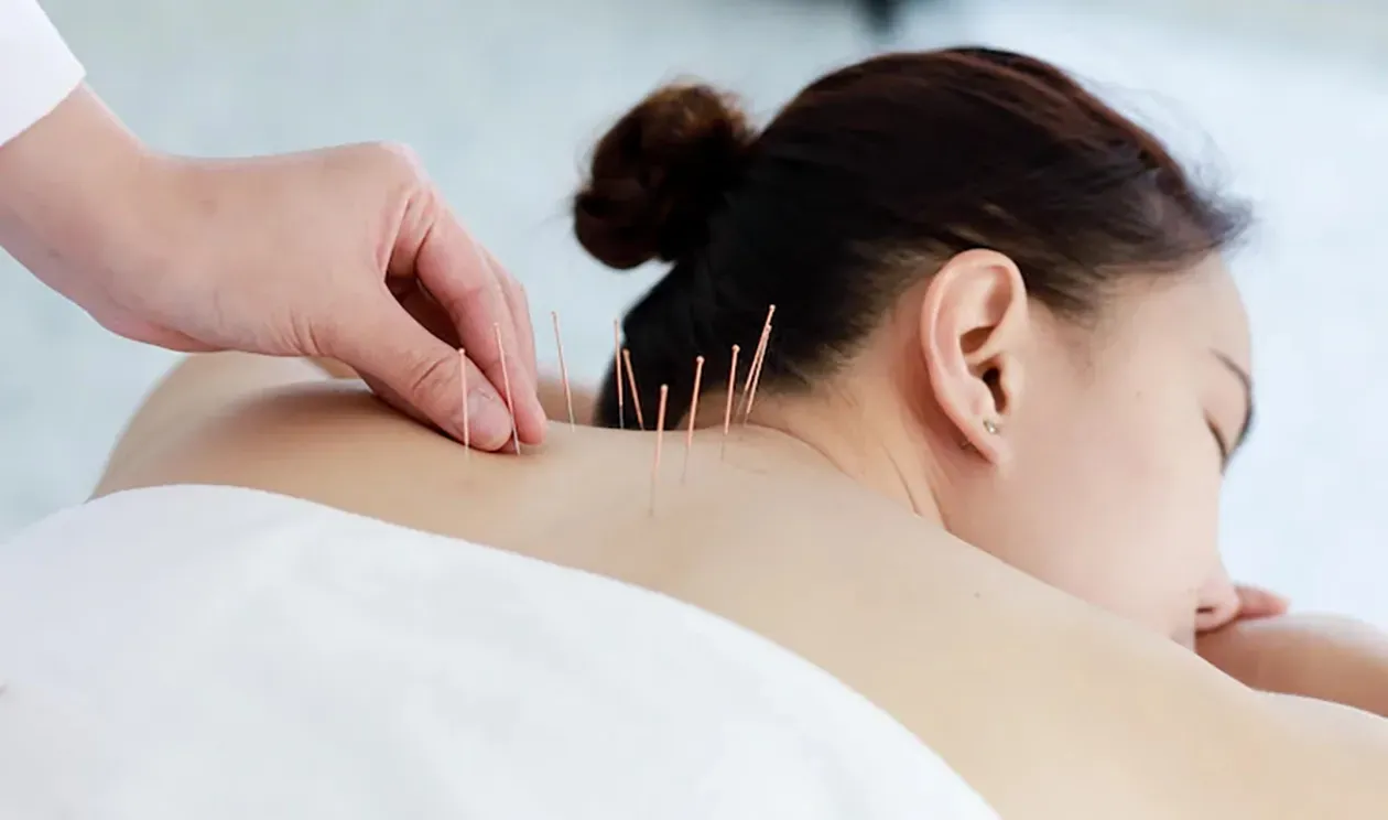 Profissional aplicando acupuntura em paciente para aliviar dores. Uma pessoa recebendo tratamento de acupuntura. Agulhas são inseridas em suas costas manualmente.