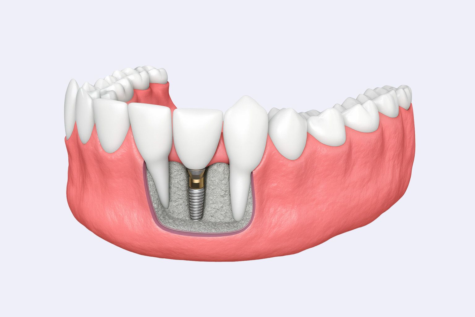 Illustration of dental implant in lower jaw, showing metal post embedded in bone with crown attached.