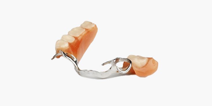 Partial denture with metal clasps and artificial teeth.