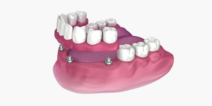 Dental implants with a full set of teeth, pink gums, and white teeth, in a mouth model.