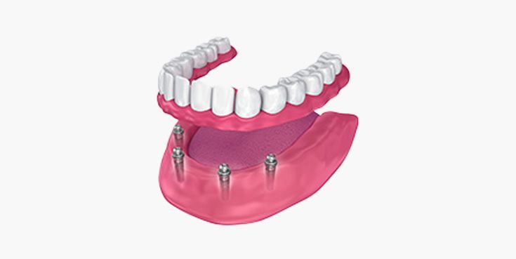 Dental implants with dentures, a dental procedure showing lower jaw implants supporting upper and lower dentures.