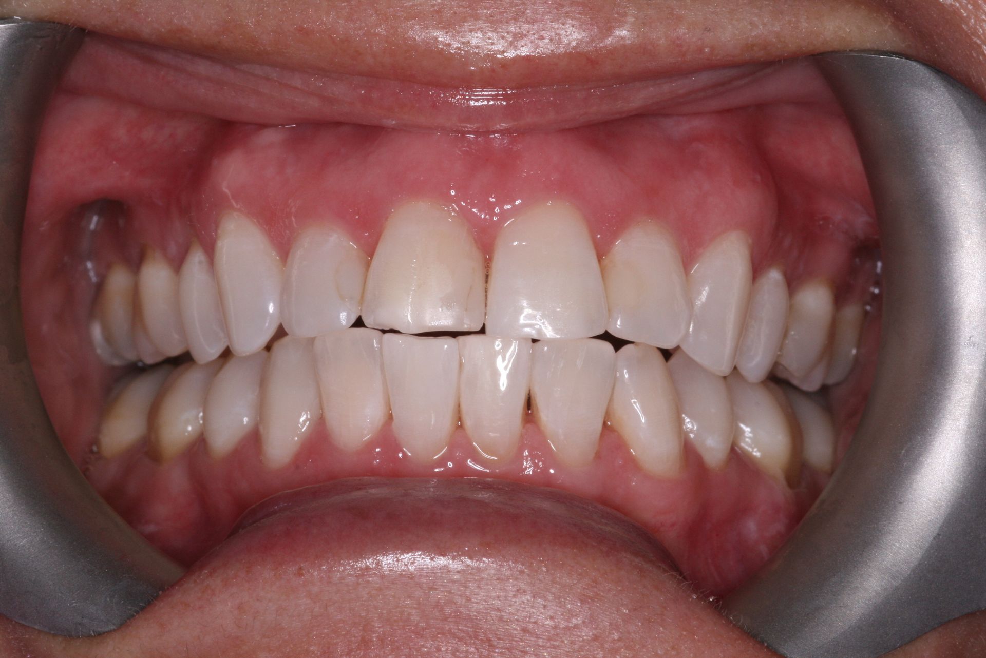 Close-up view of teeth and gums, light yellow teeth, pink gums.