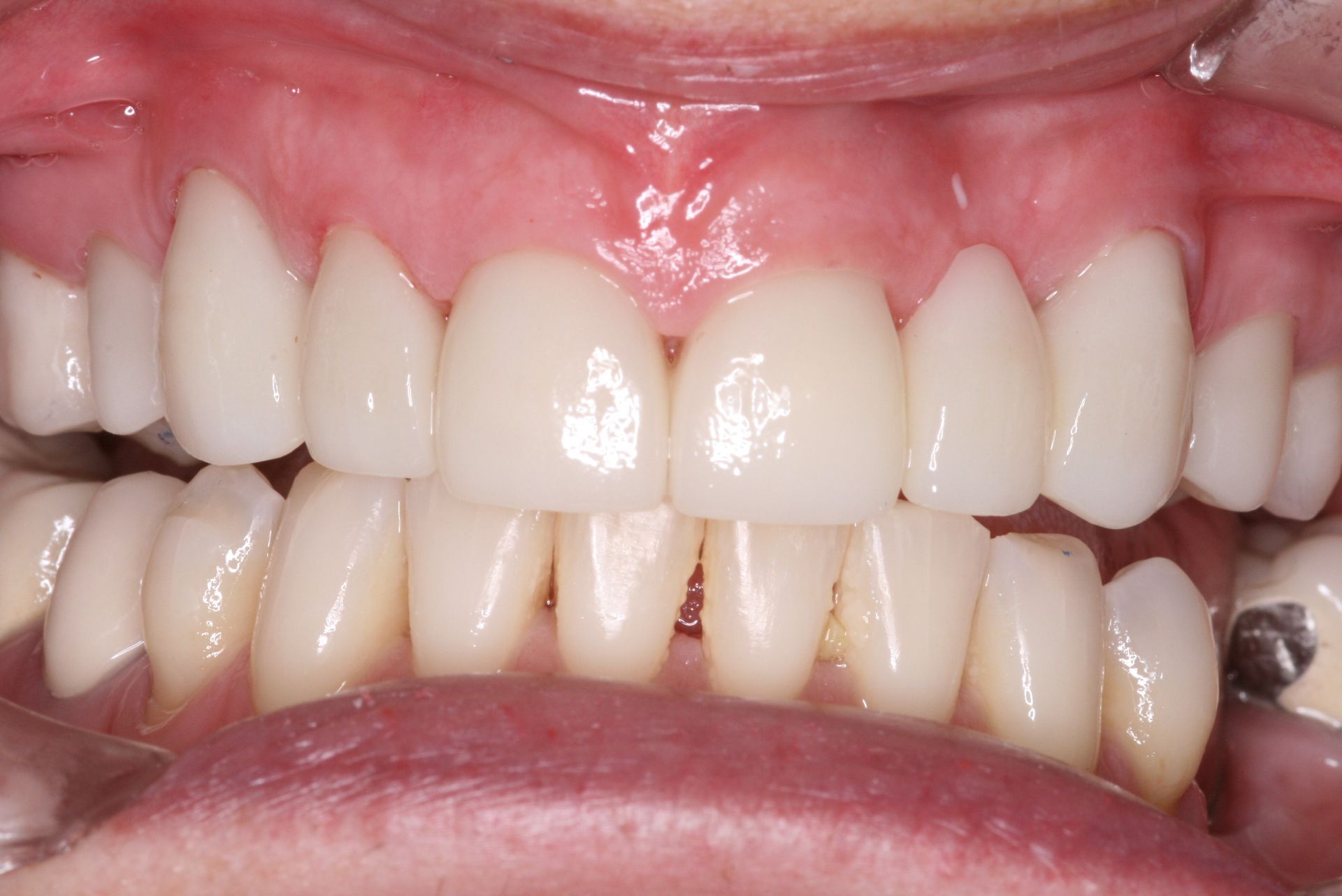 Close-up view of teeth and gums, light yellow teeth, pink gums.