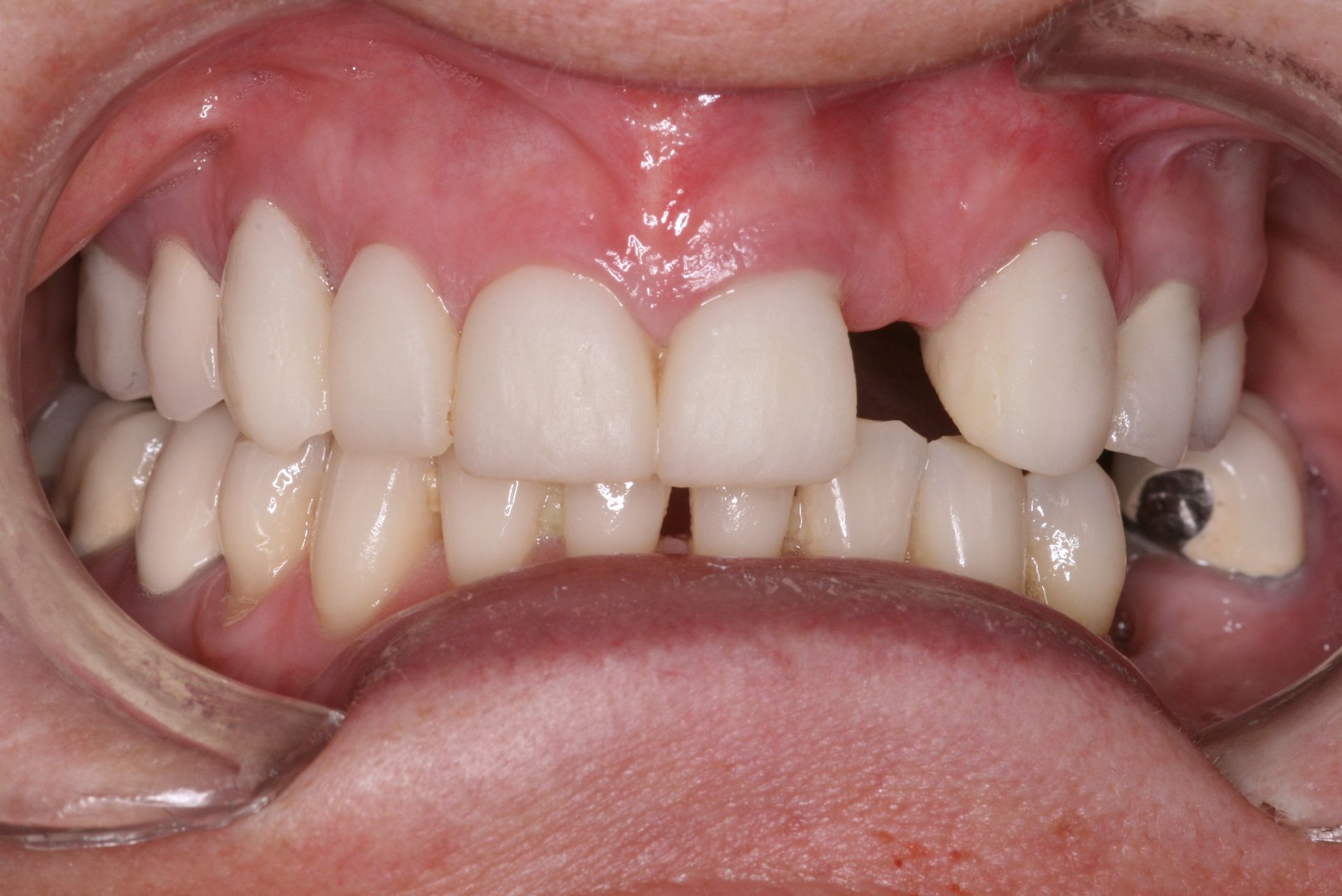 Close-up of human teeth, showing the upper and lower rows, slightly yellowed with a visible gum line.