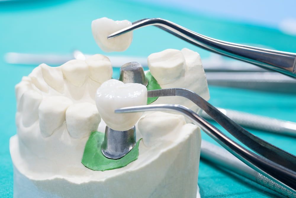 A Model of A Tooth with A Crown and Dental Instruments — Bromley's Denture Clinic in Tweed Heads South, NSW