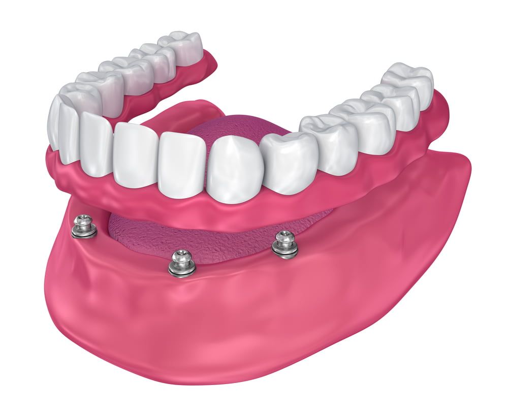 A 3d Rendering of A Full Denture with Screws Attached to It — Bromley's Denture Clinic in Tweed Heads South, NSW