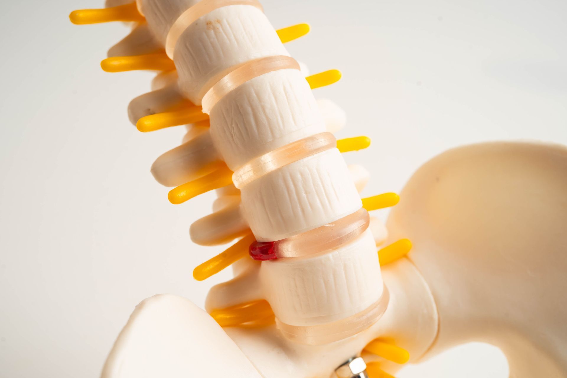 estenose central e lateral