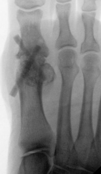 Operation mit Shark Screw - Hallux rigidus
