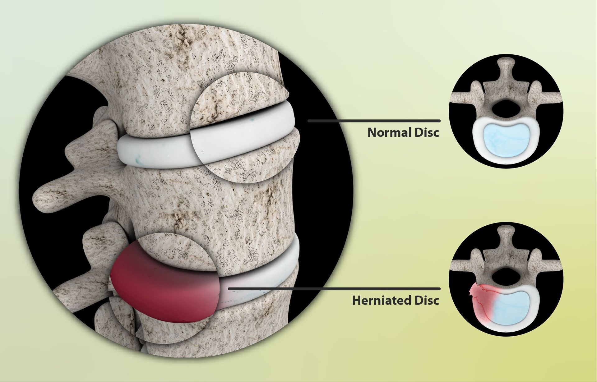 Render of a 3D depiction of a herniated disc
