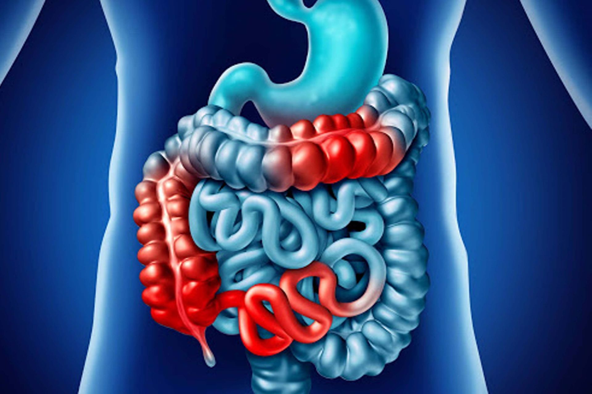 La Enfermedad Inflamatoria Intestinal (EII) es una afección crónica 