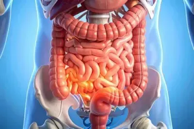 La colitis ulcerosa es una enfermedad crónica inflamatoria del intestino 