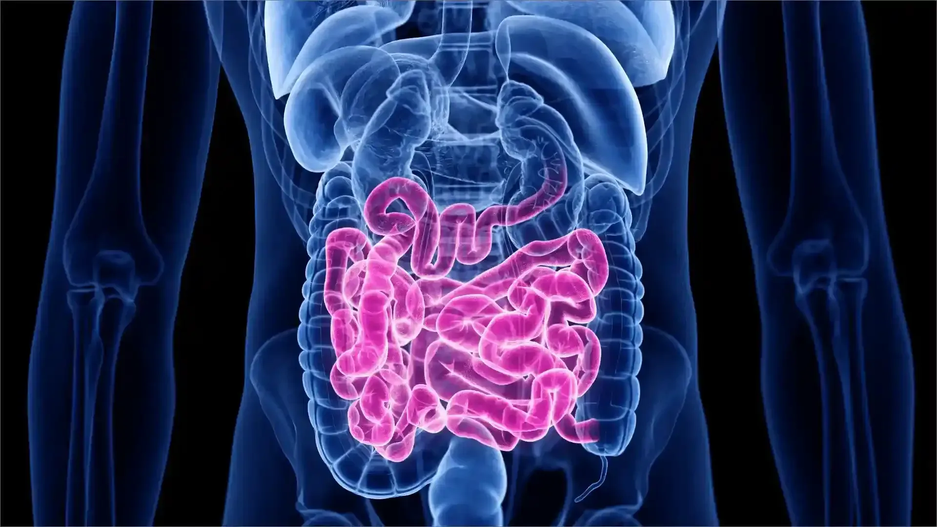 Crohn’s disease is a chronic form of inflammatory bowel disease (IBD)