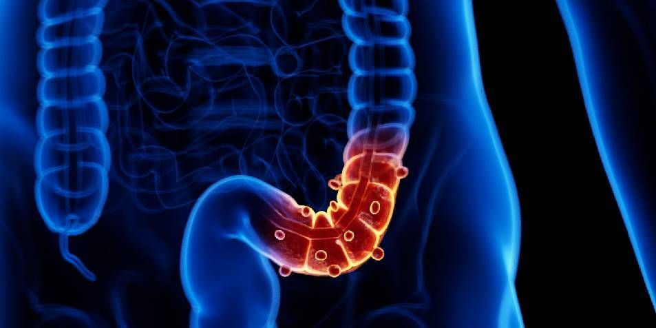 El estreñimiento es un problema gastrointestinal común 