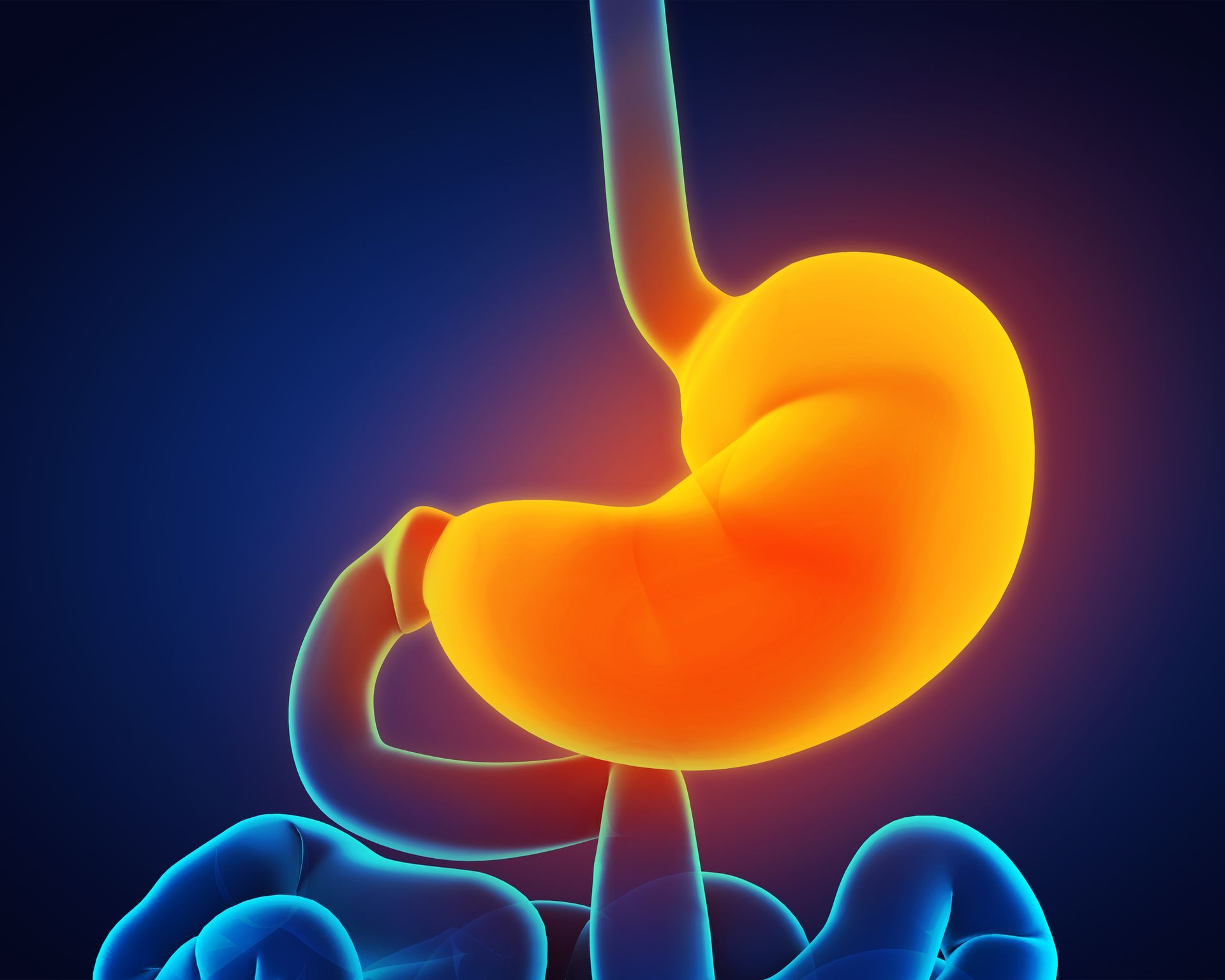 Gastroparesis is a digestive disorder characterized by delayed emptying of the stomach