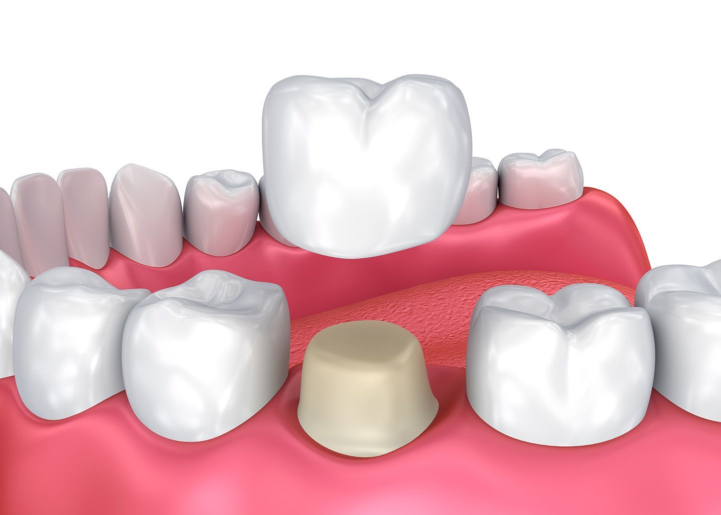 Dental Implant