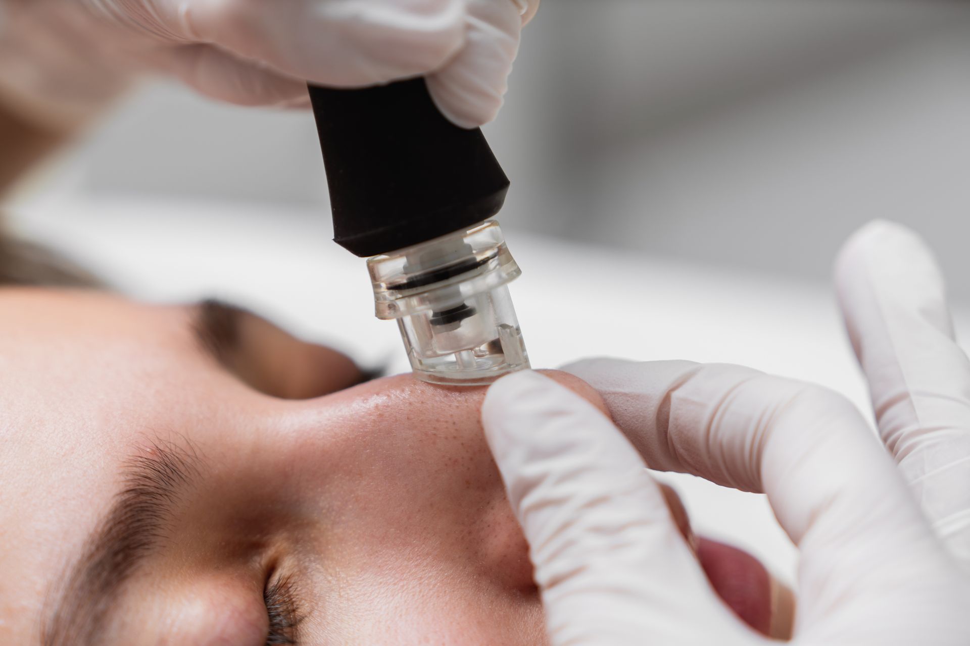A gloved professional uses a vacuum-suction facial device on the bridge of a person’s nose in a clinical setting.