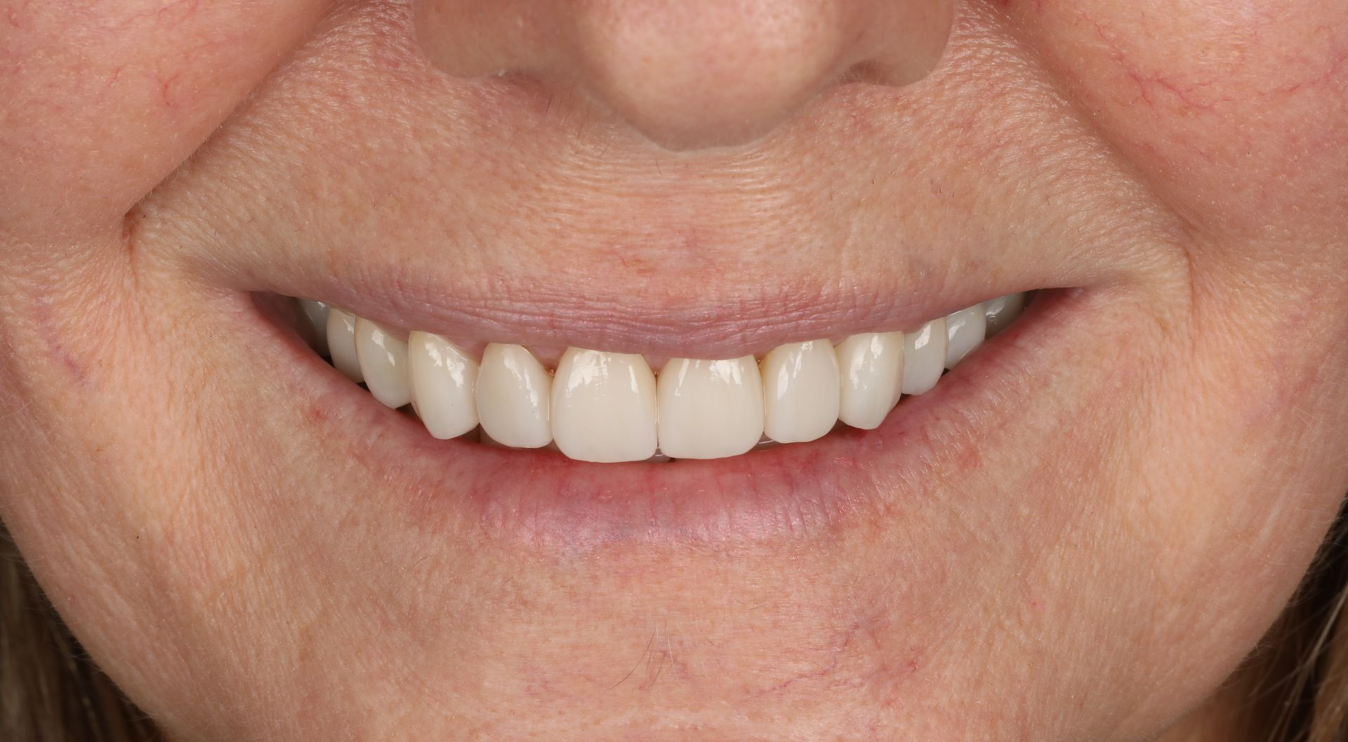 Close-up of a person's smiling mouth showing straight, white teeth and pink lips.