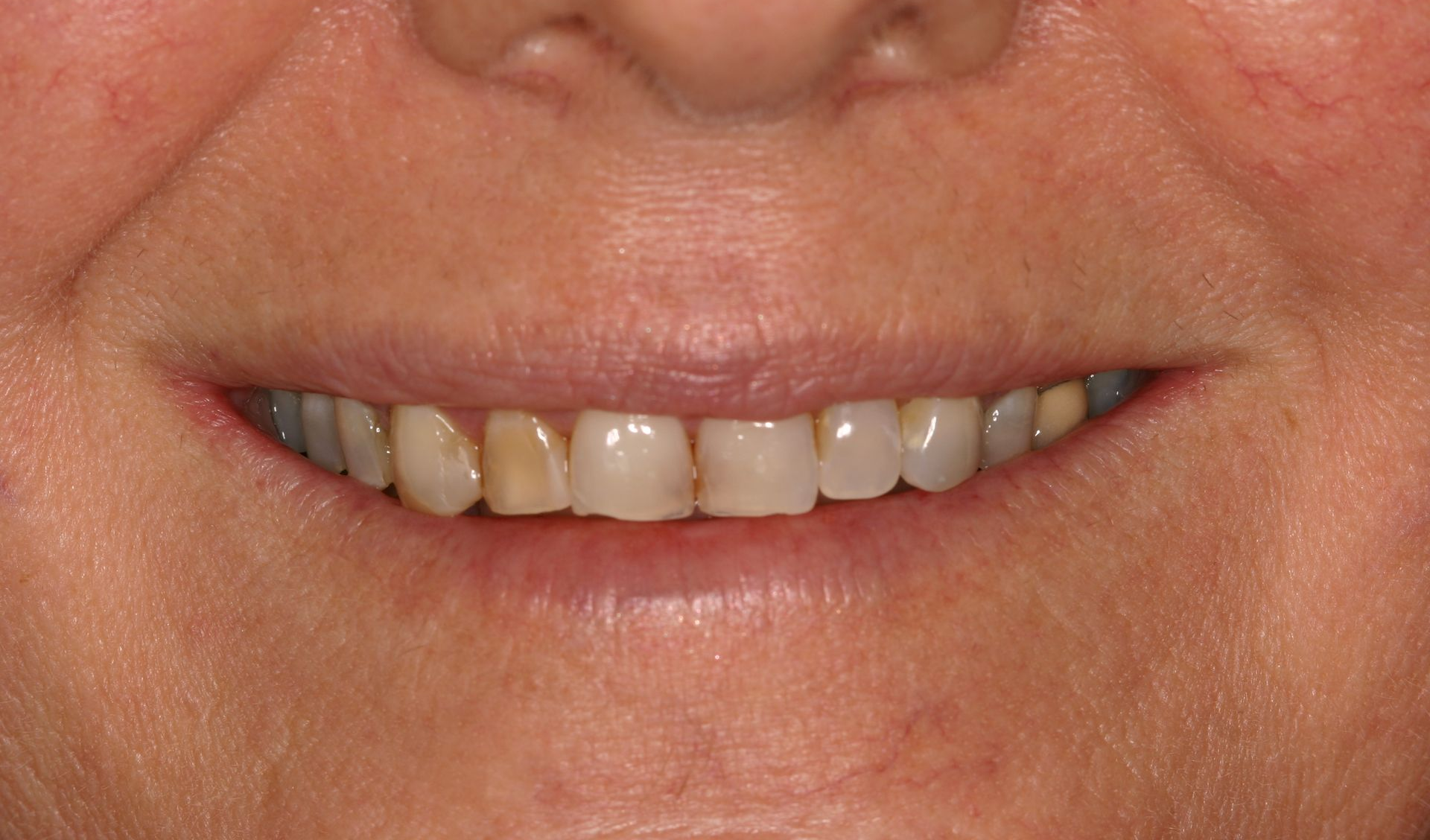 Close-up of a person's smiling mouth showing teeth with a noticeable gap between the two front teeth.