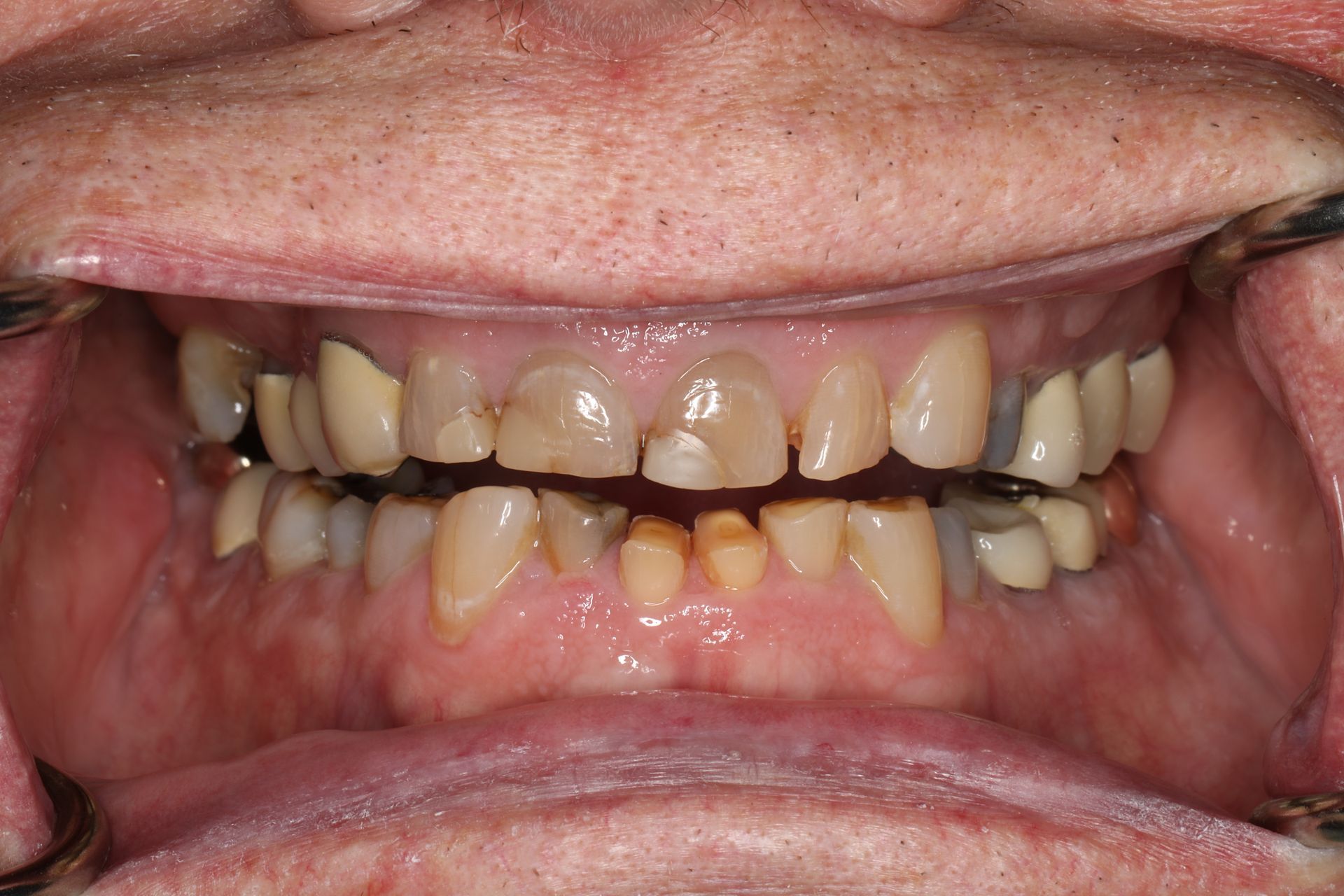 Close-up of a person's teeth, showing discoloration and gaps.