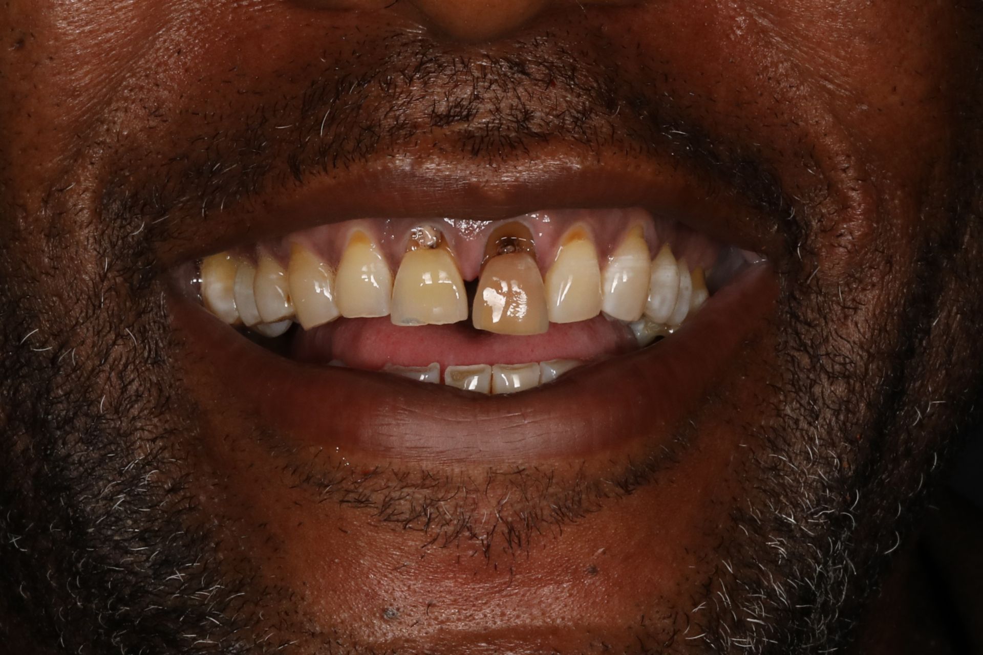 Close-up of a person's teeth, showing discoloration and gaps.