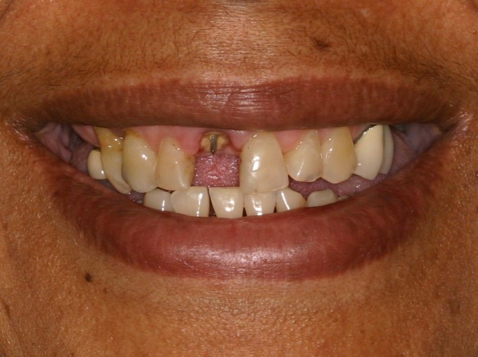 Close-up of a person's teeth, showing discoloration and gaps.