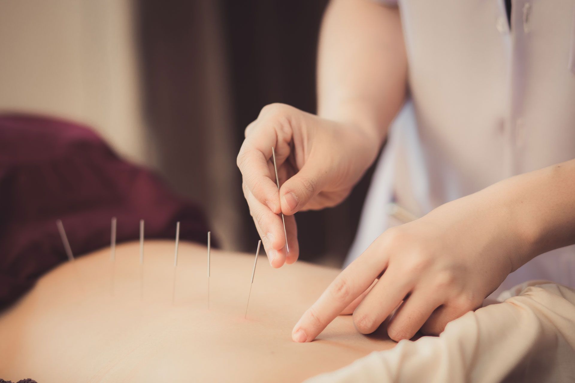 Acupuncturist inserting needles into a patient's back during a treatment session.