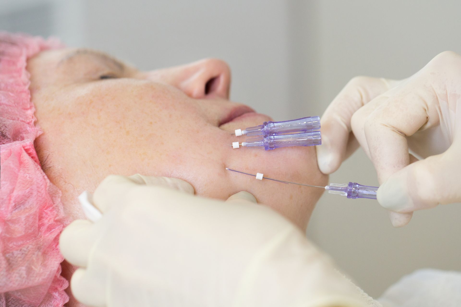 Gold Thread Injections Mini Thread Lift - Neck & Cheeks | Legacy Dermatology - Algonquin, IL