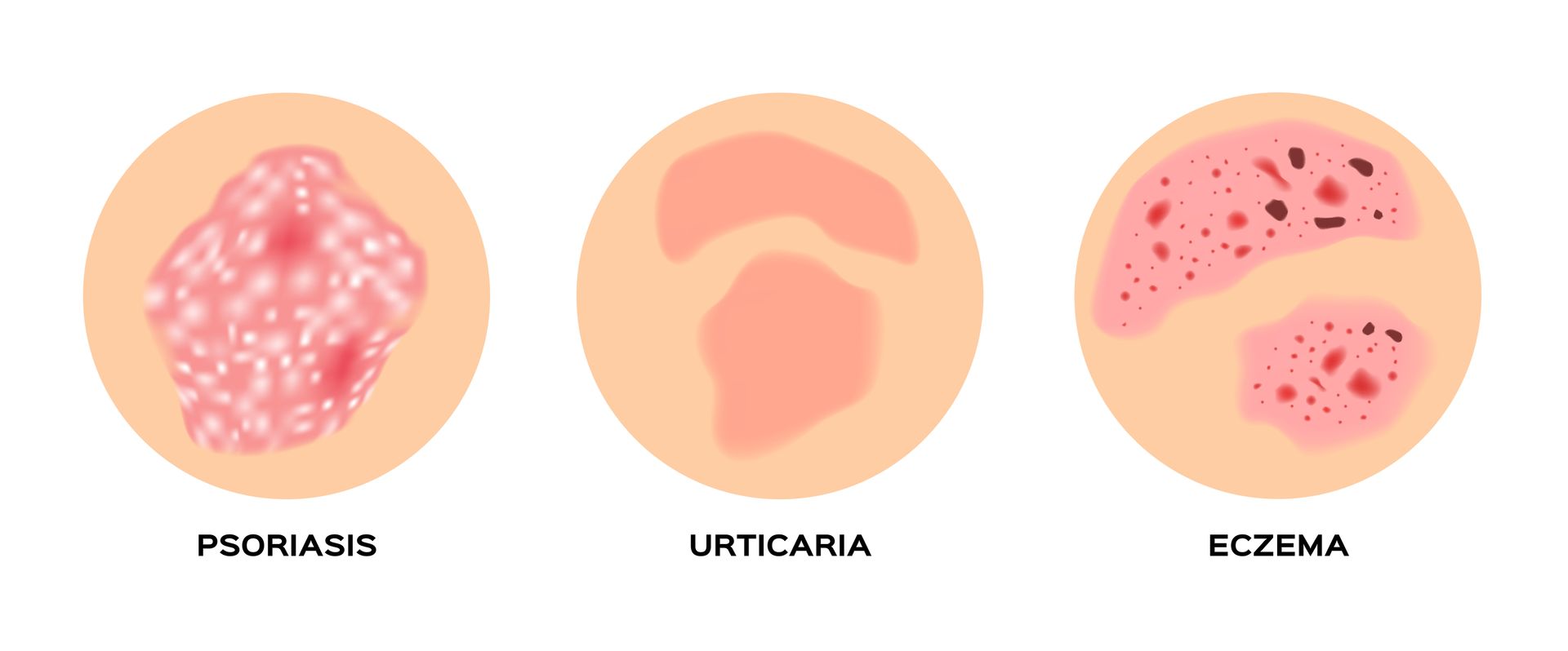 Three skin condition diagrams labeled psoriasis, urticaria, and eczema.