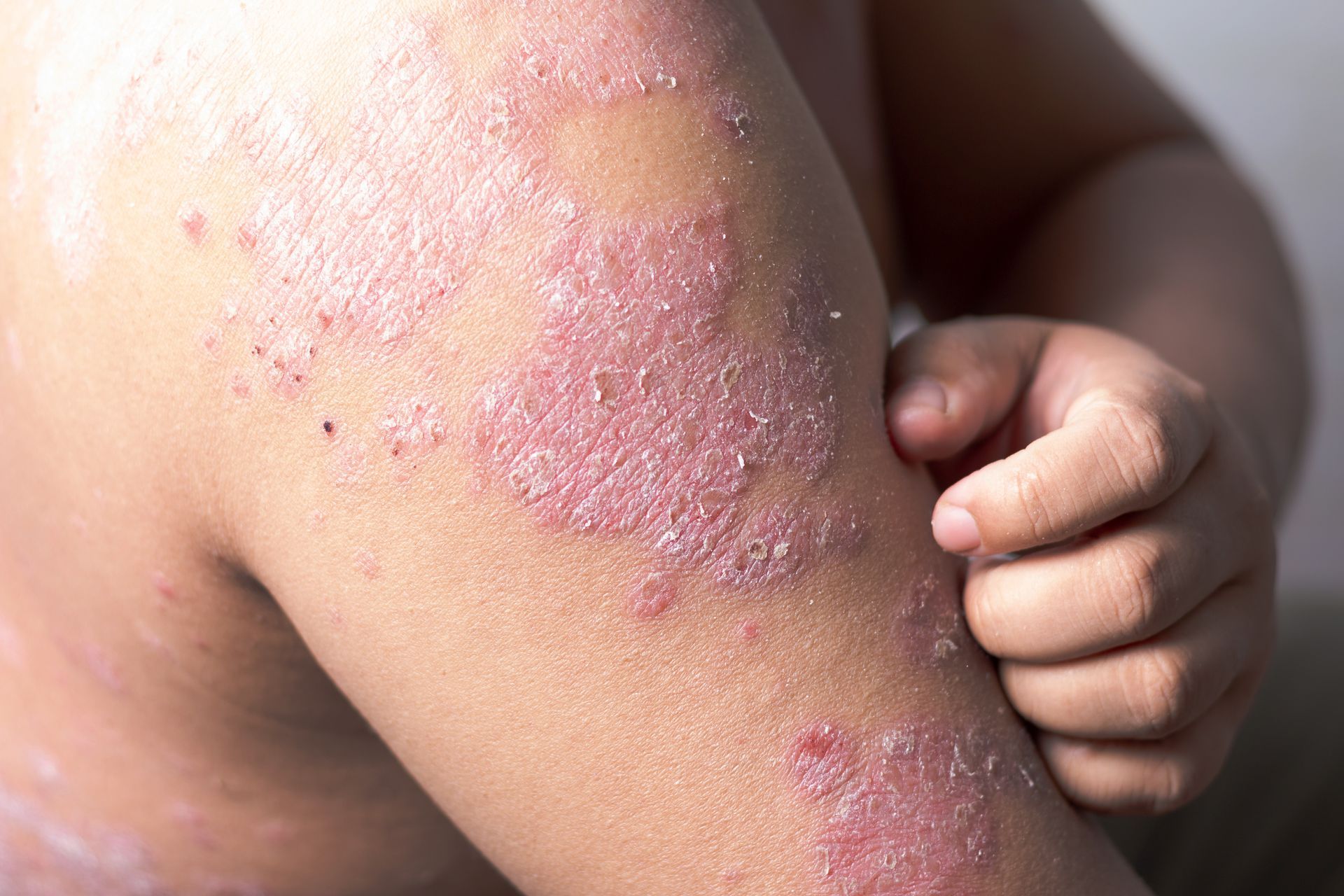 Close-up of a child’s arm with a red, scaly rash and scratching hand
