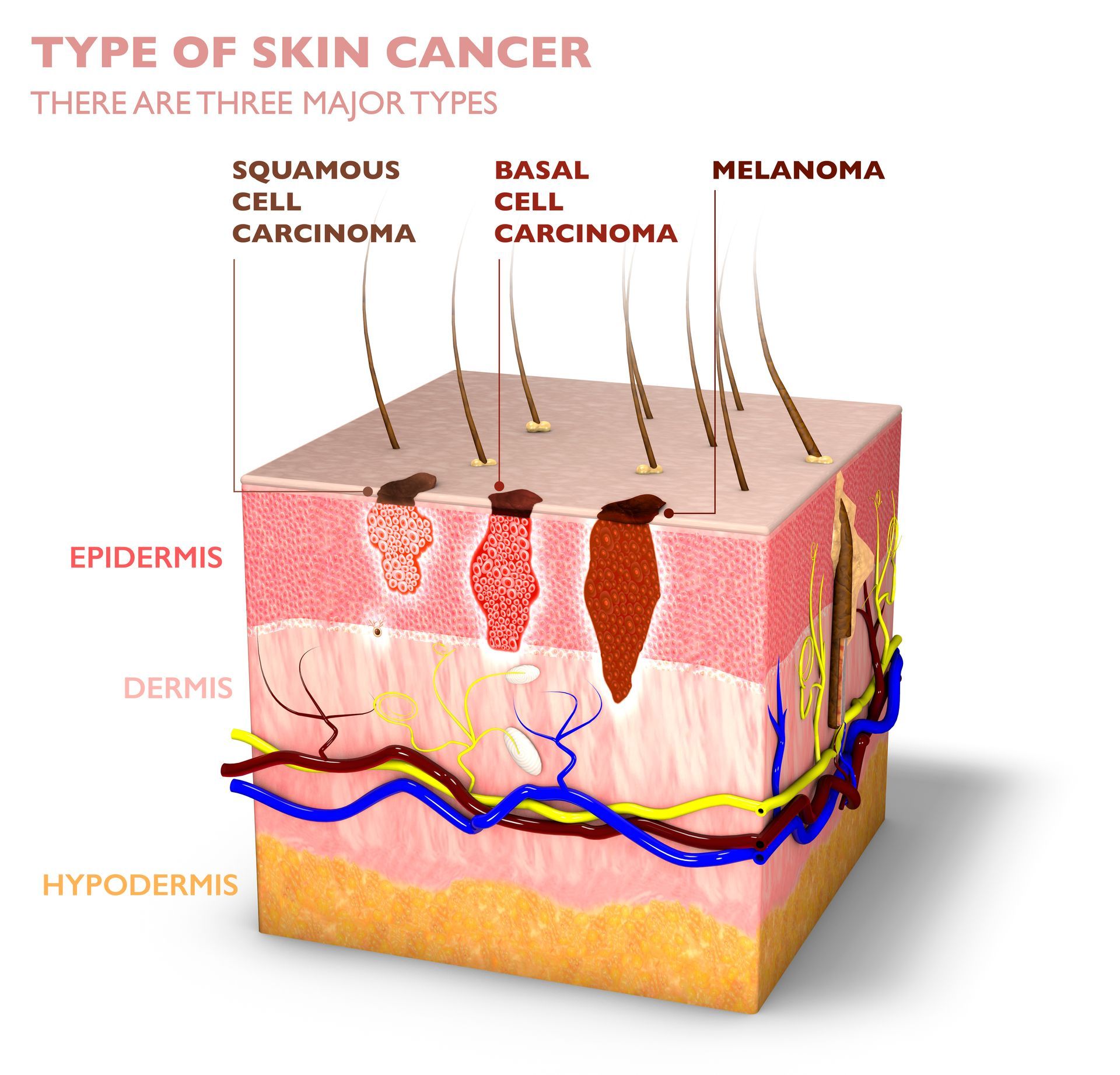 Diagram of skin layers showing squamous cell carcinoma, basal cell carcinoma, and melanoma lesions.