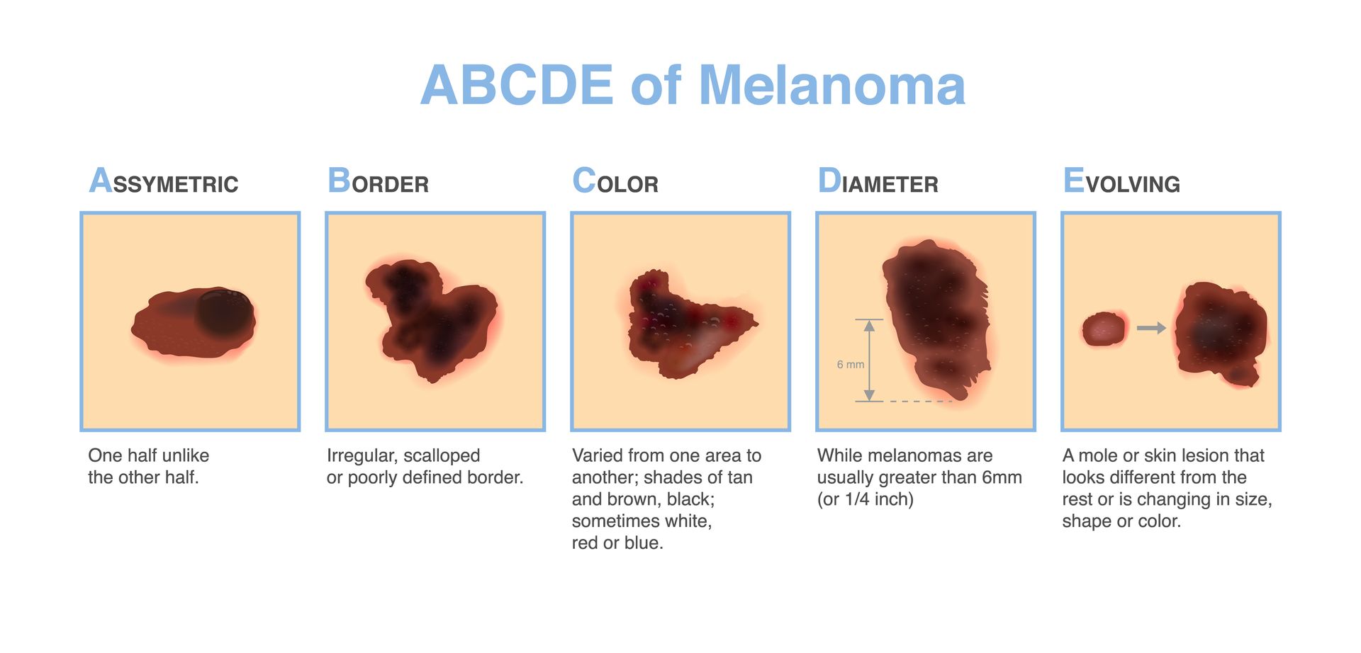 The ABCDE guide to identifying melanoma skin cancer, showing five visual examples of irregular mole characteristics.