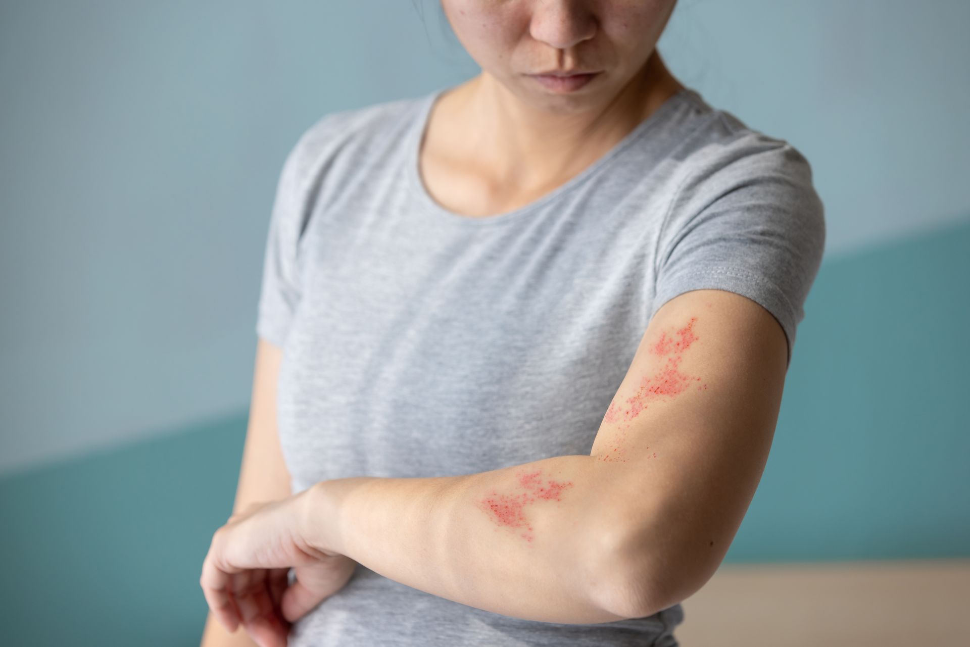 Person in gray shirt scratching red rash on forearm against a blue wall