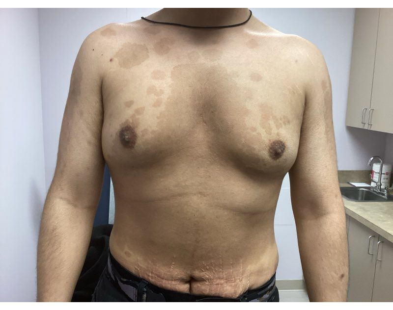 Torso of a person with multiple light brown skin patches, standing in a clinic exam room