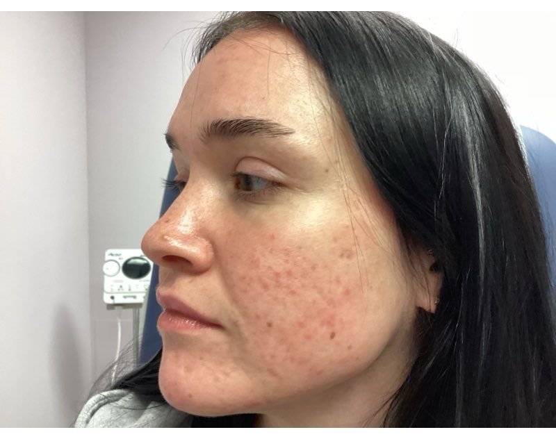 Close-up side profile of a person with red acne blemishes on their cheek, in a clinic setting