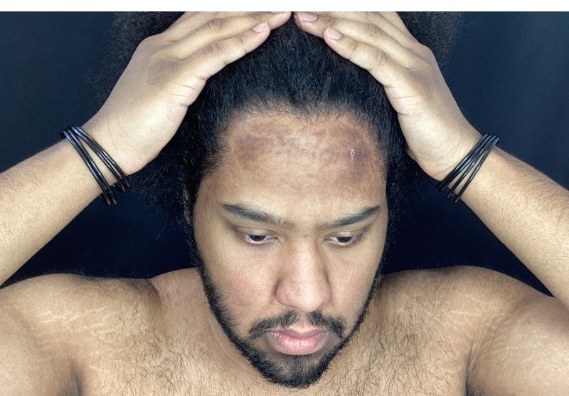 Person holding their head with both hands, looking down with a worried expression on a dark background