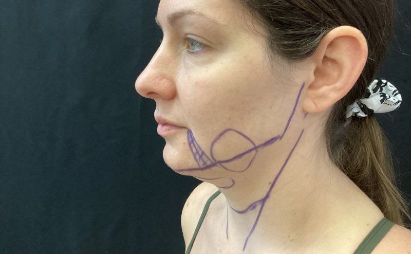 Side profile of a woman with purple marker lines tracing her jaw and neck on a dark background
