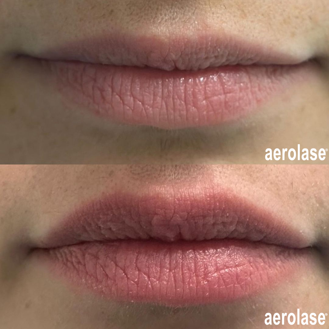 before and after aerolase neo treatment for skin rejuvenation - legacy dermatology 
