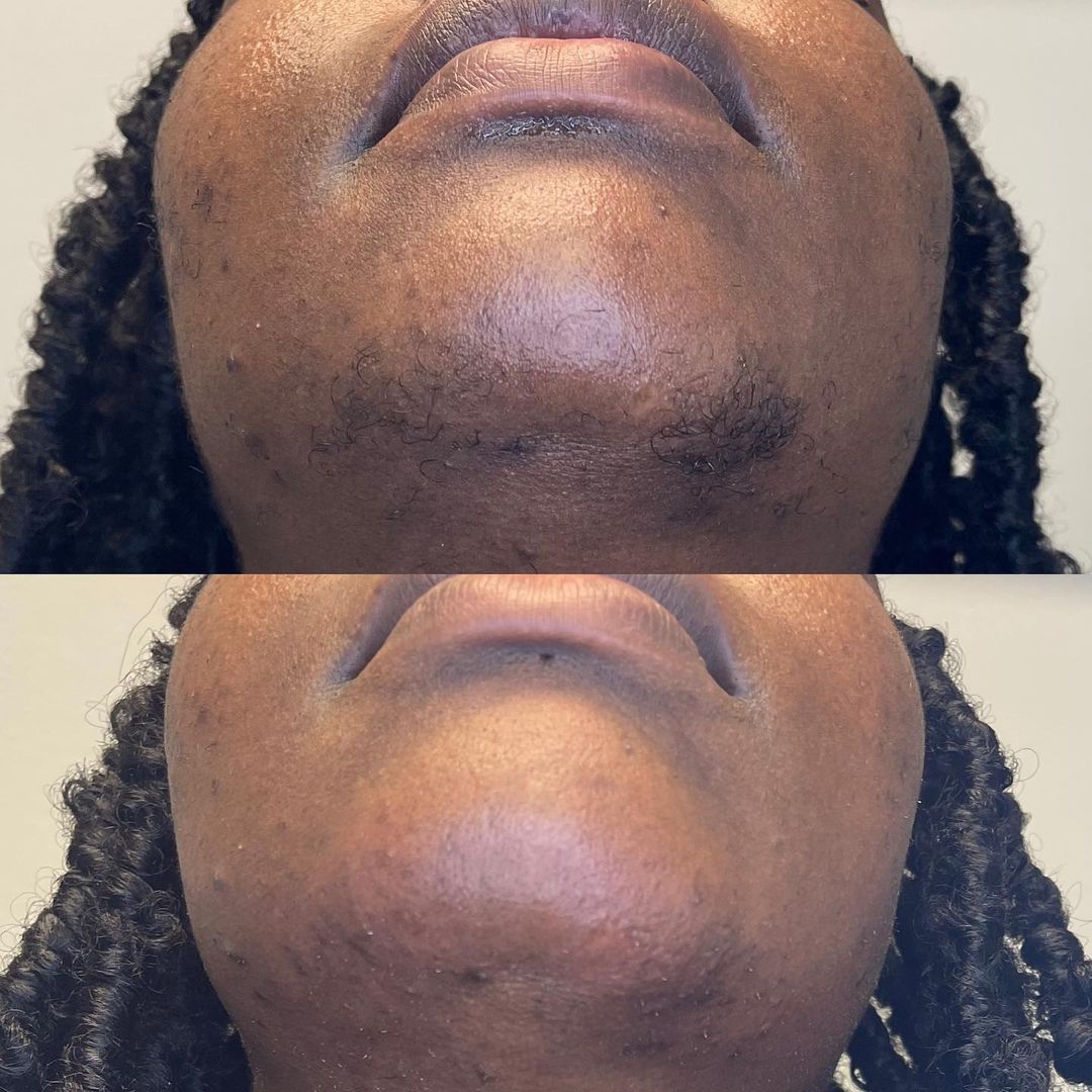 before and after aerolase neo treatment for skin rejuvenation - legacy dermatology 