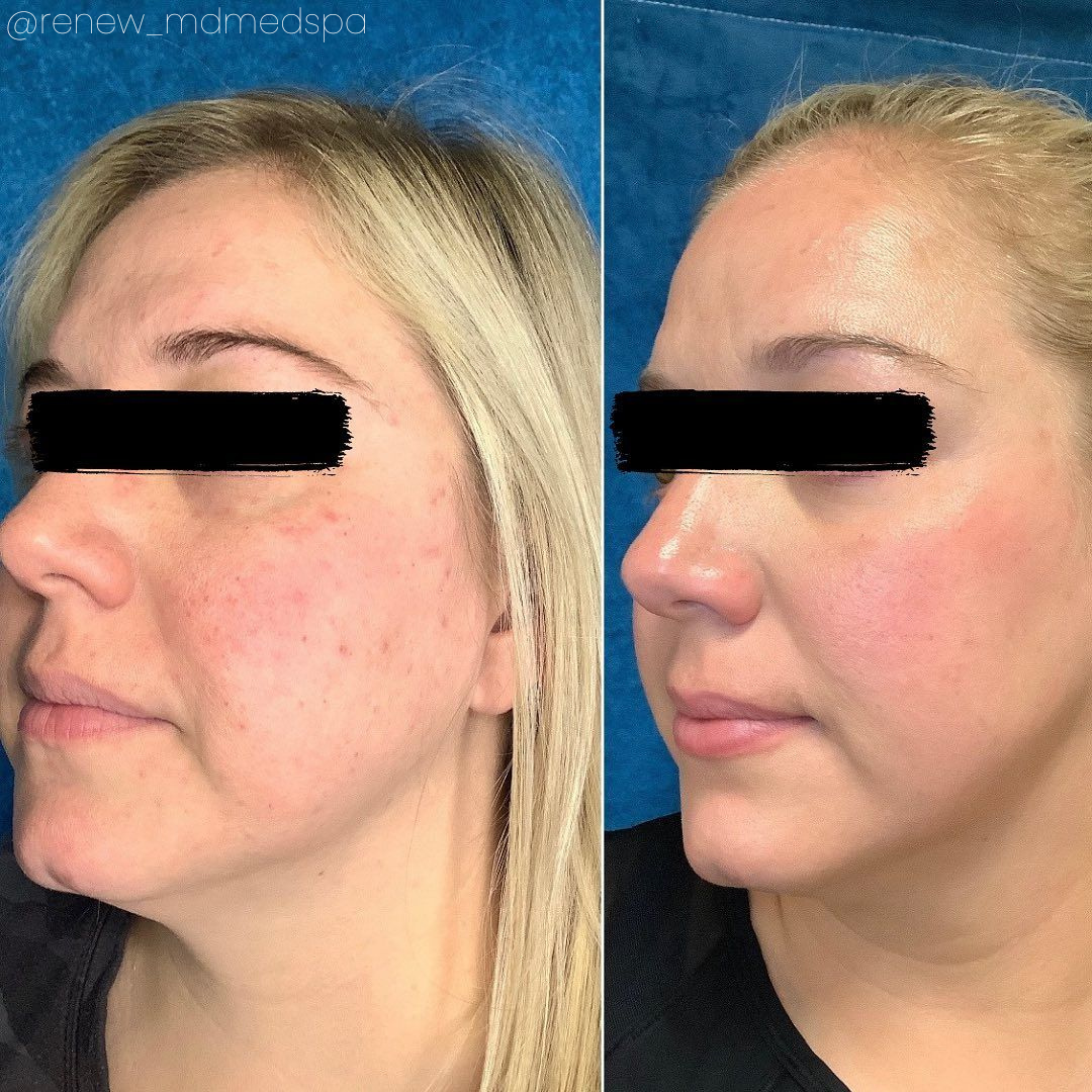 before and after aerolase neo treatment for skin rejuvenation - legacy dermatology 