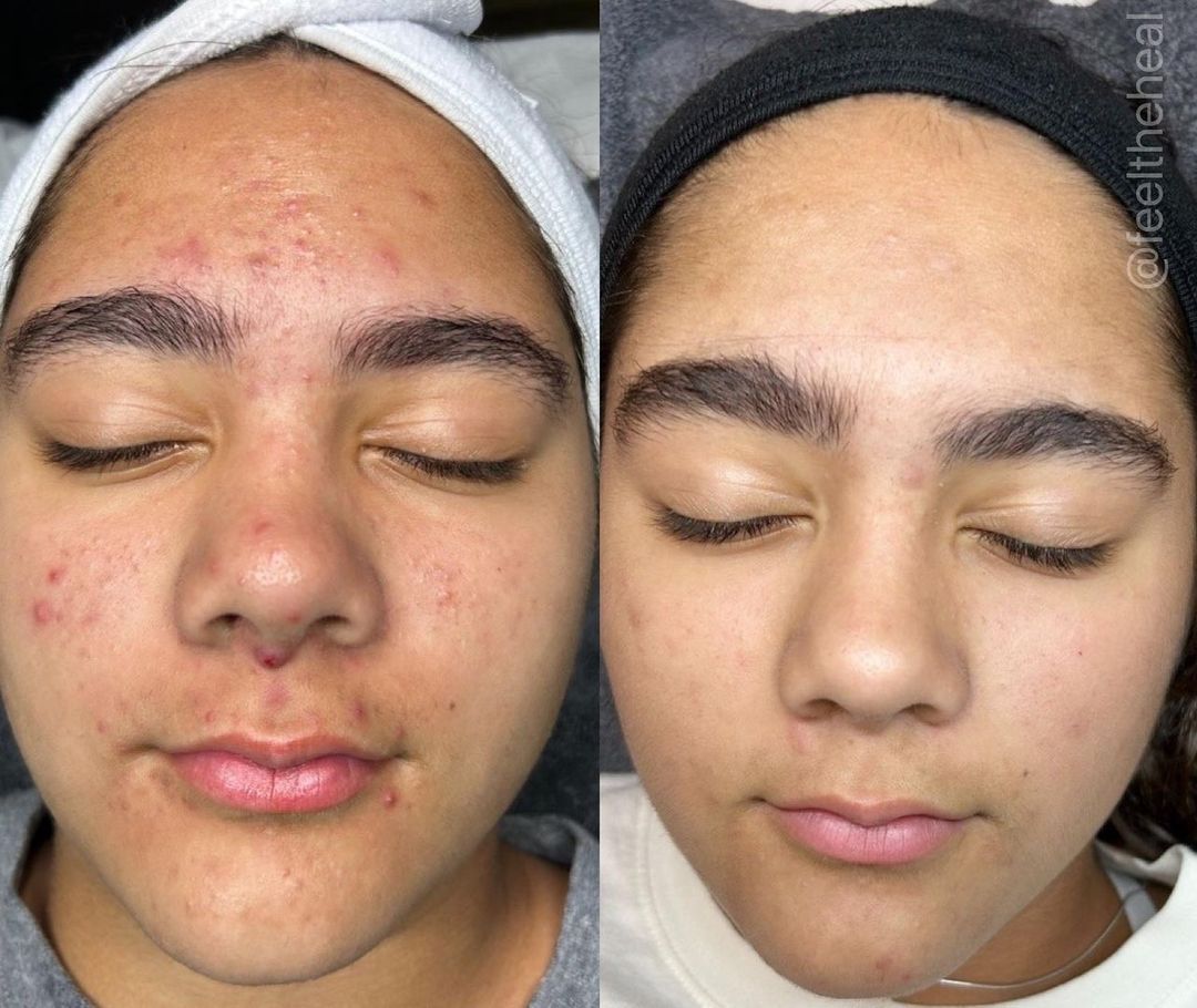 before and after aerolase neo treatment for skin rejuvenation - legacy dermatology 